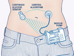 Artificial pancreas.